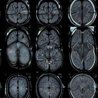 Biopsia cerebral de lóbulo frontal derecho