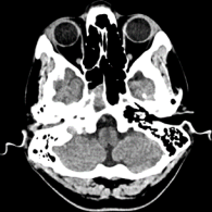 Programa de la subespecialidad en Neuropatología