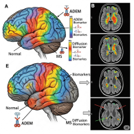 Pehlivan E, Mwangi MK, Abraham V, Mange U, Song SK, Sun P, Mar SS. Differentiating Pathology of Acute Disseminated Encephalomyelitis From Multiple Sclerosis in Children Using Diffusion Magnetic Resonance Biomarkers. 