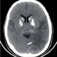 Mitochondrial Encephalomyopathy, Lactic Acidosis, and Stroke-like Episodes (MELAS) Syndrome: Frequency, Clinical Features, Imaging, Histopathologic, and Molecular Genetic Findings in a Third-level Health Care Center in Mexico. Neurologist